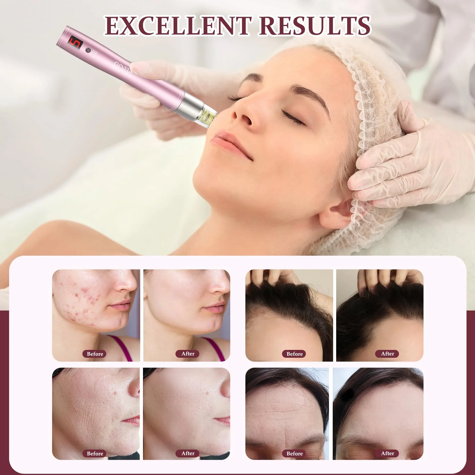 PELCAS Dermapen Aplicador Automático de Suero 5 Niveles Profesional con 6 Cartuchos Oro Rosa