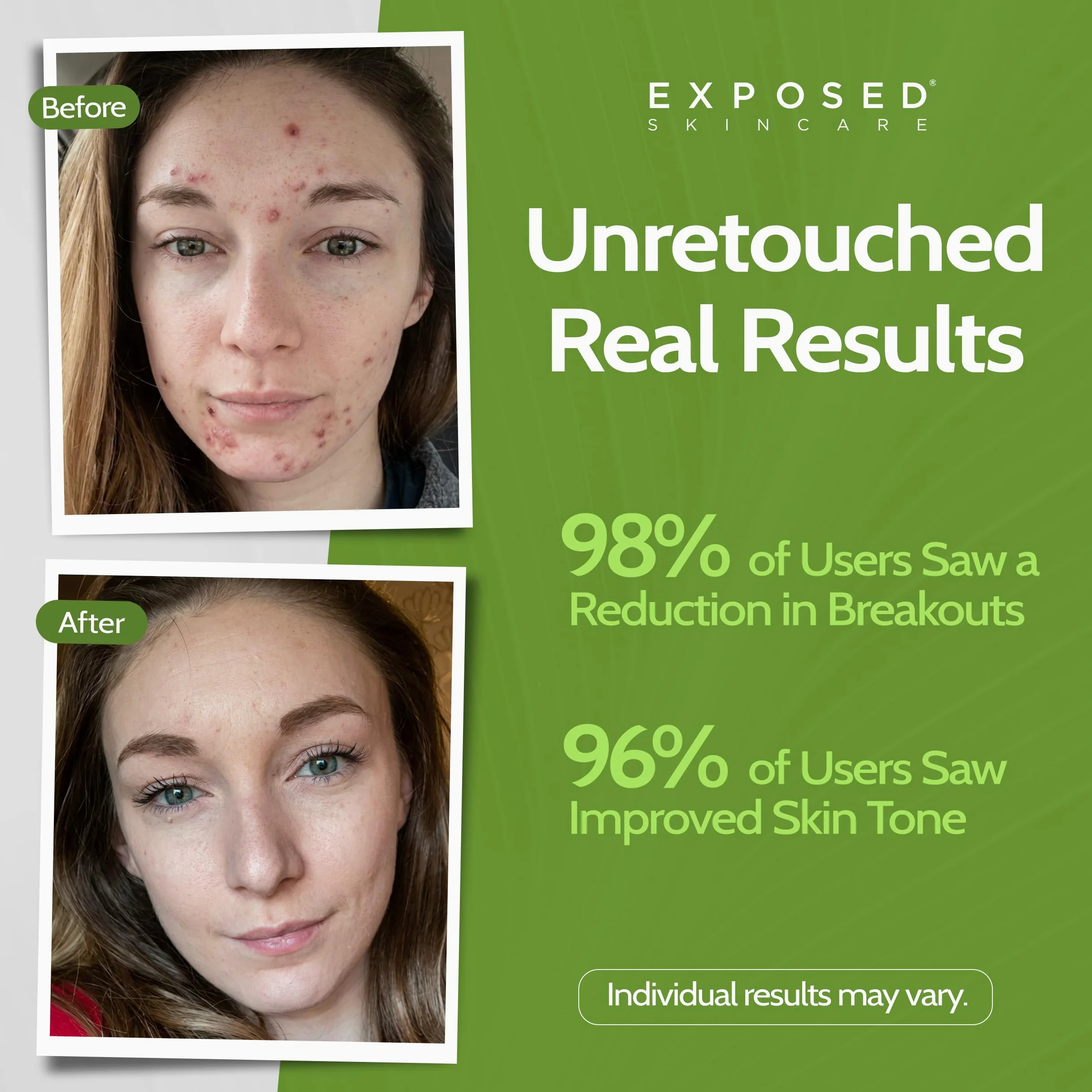 Exposed Skin Care Kit de tratamiento para el acné - Solución natural para el acné para el rostro, todos los tipos de piel y edades - Contiene detergente, tónico, suero, suero limpiador de poros